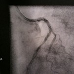 Stent in place